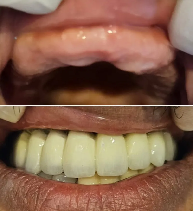 Before and after - implants & prosthetics