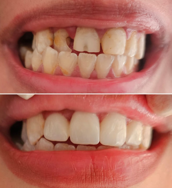 Before and after - cosmetic restorations