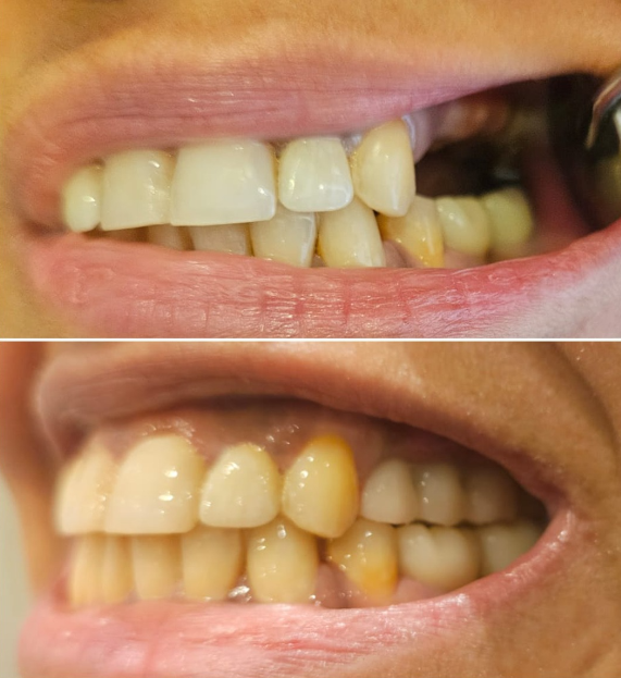 Before and after - aesthetic dentistry