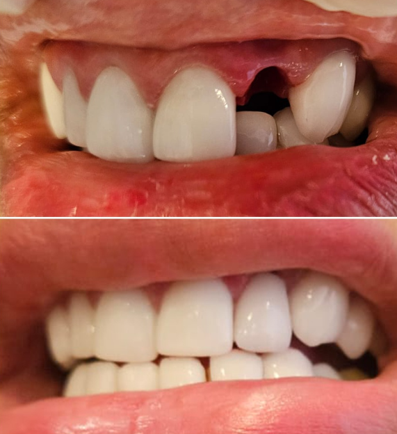 Before and after - anterior implants