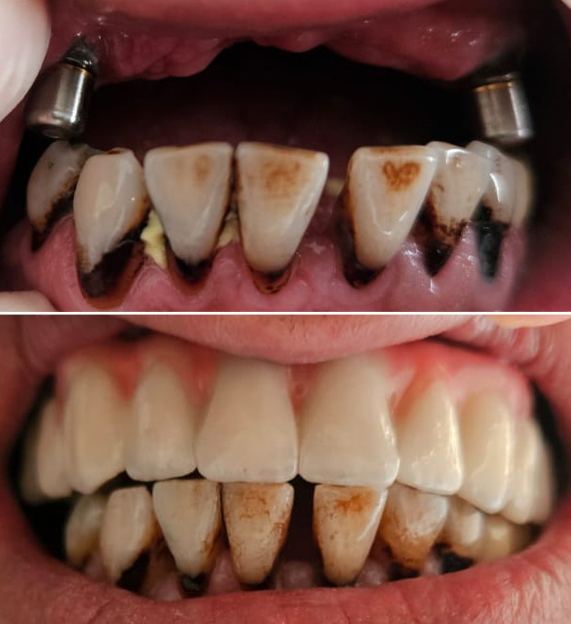 Before and after - full implant restoration