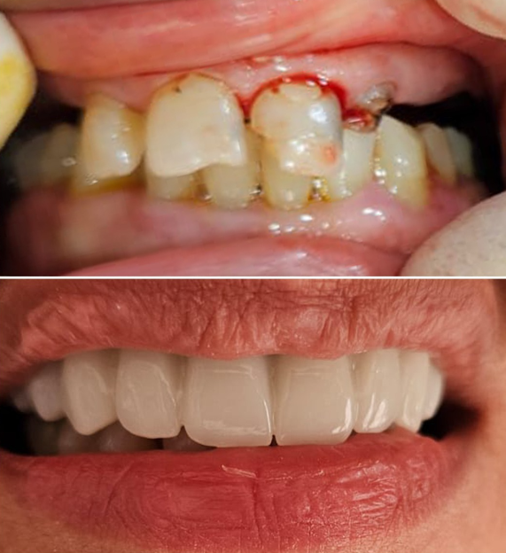 Before and after - fixed prosthetics
